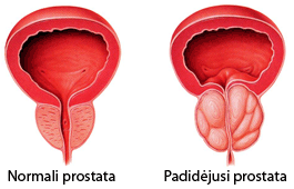 prostatos uždegimas vyrams)